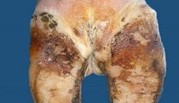 How to treat foul in the foot
